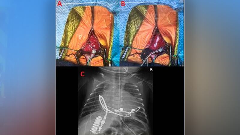 A 1.16 by 0.65 by 0.38-inch, 0.18-ounce pacemaker was implanted in a child during a two-hour...